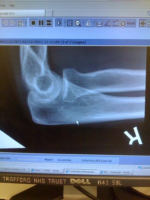 Elbow in pictures...